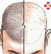 Hair transplant