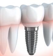 global bio-implants market