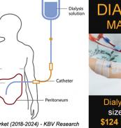 Global Dialysis Market- KBV Research