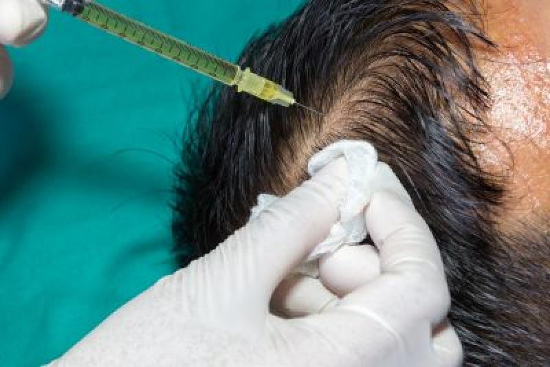زراعة الشعر في تركيا