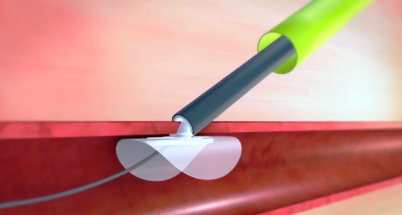 Peripheral vascular device market forecast Peripheral vascular device market forecast