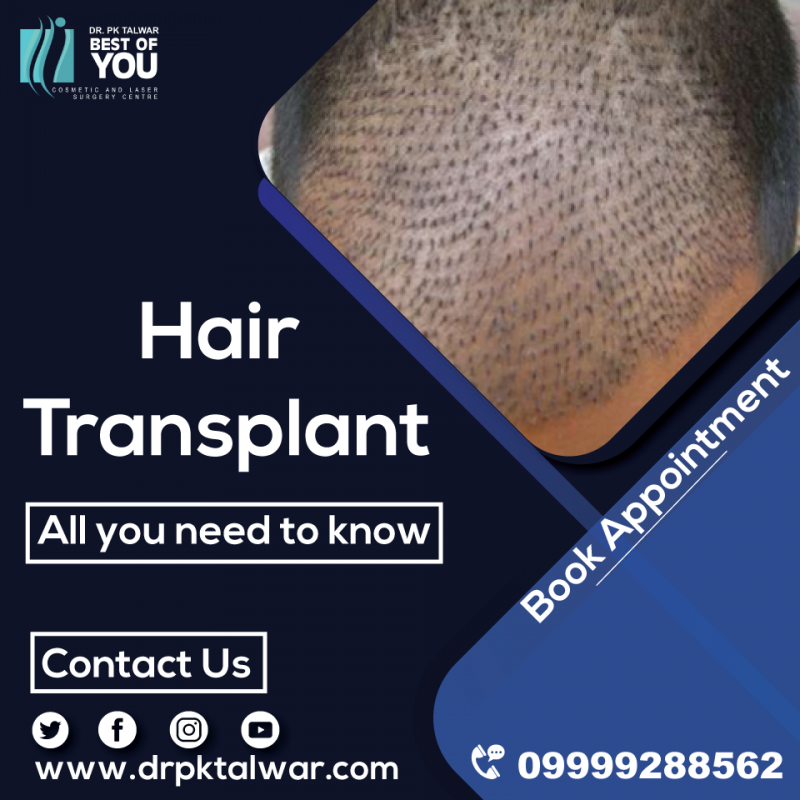 Hair Transplant Surgery in Delhi