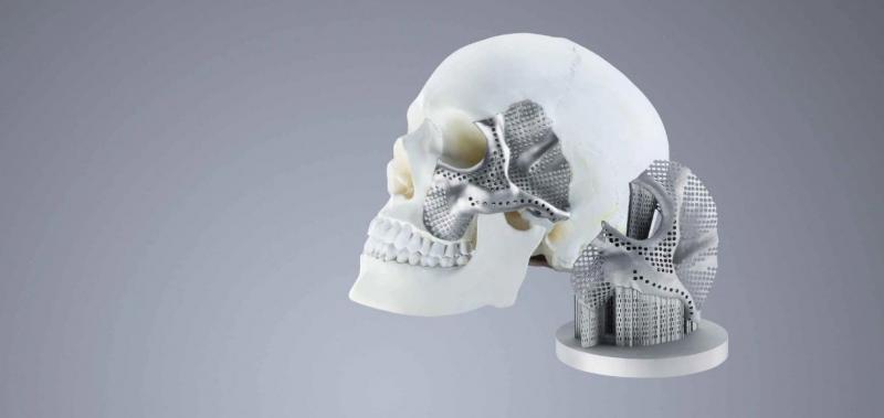 3D Printed Medical Implants Market Share, Restraints, Segments And Regions