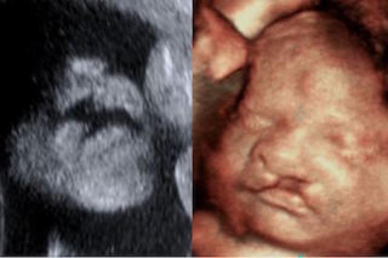 3D Ultrasound Imaging is Estimated to Witness High Growth Owing to Advancement in Ultrasound Technology