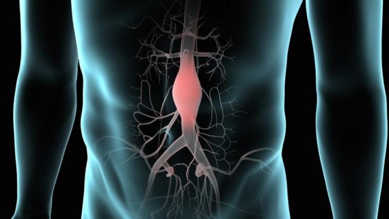 Abdominal Aortic Aneurysm