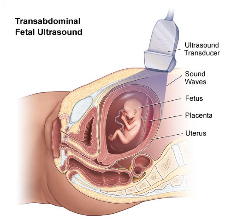 Achondroplasia Treatment Market