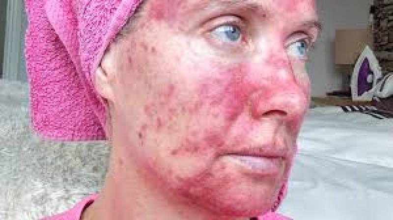 Actinic (Solar) Keratosis Treatment Market