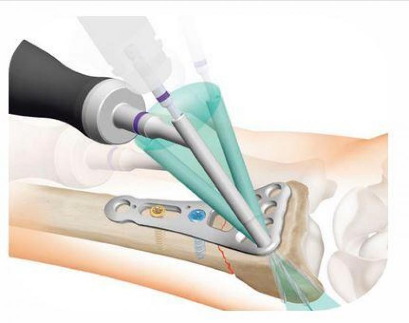 Adjustable Bone Plate 