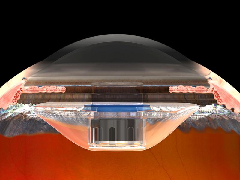 Age-Related Macular Degeneration (AMD) Industry