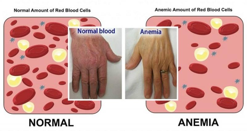 Anemia Treatment Drugs Industry