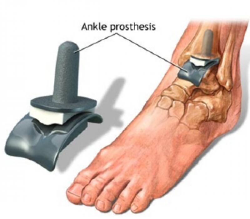 Global Ankle Prosthesis Market Research Reports Forecast 2023