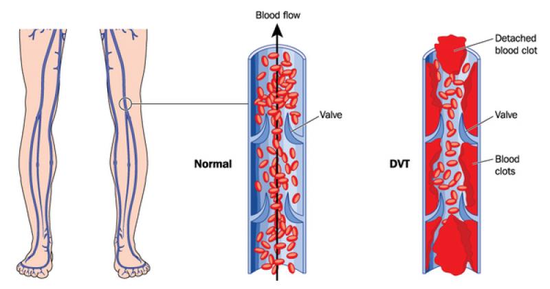 Antithrombin Market