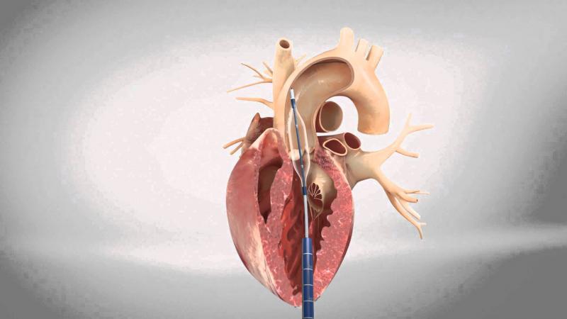 Aortic Stenosis Market 