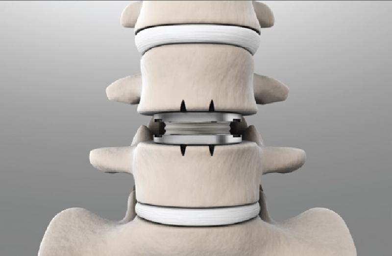 Artificial Disc Industry
