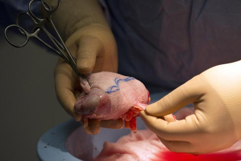 Artificial Kidney Market