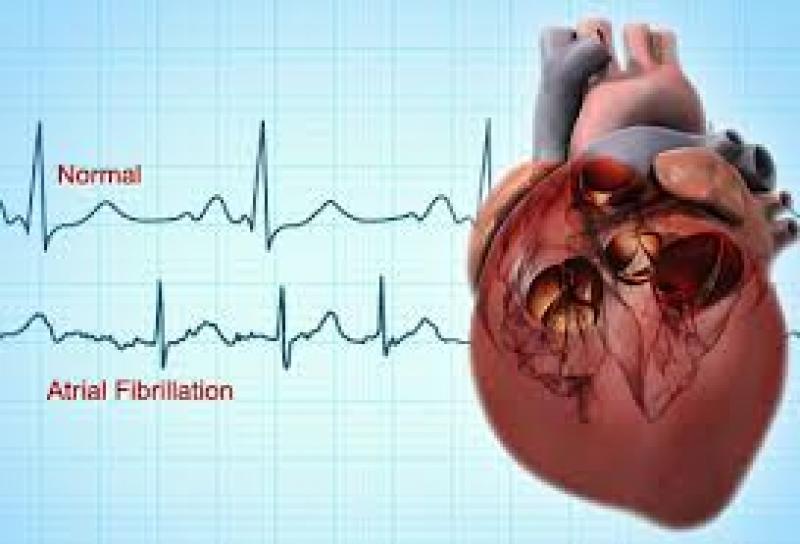 Atrial Fibrillation Pipeline Drugs, and Companies Review 2015