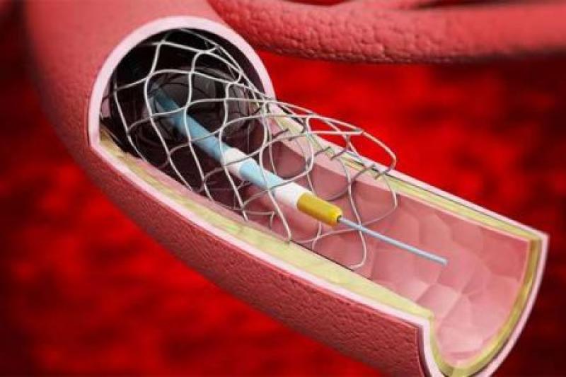 Azacitidine (CAS 320-67-2) Market Report by Manufacturers, Application, and Type Forecast to 2025 Azacitidine (CAS 320-67-2) Market