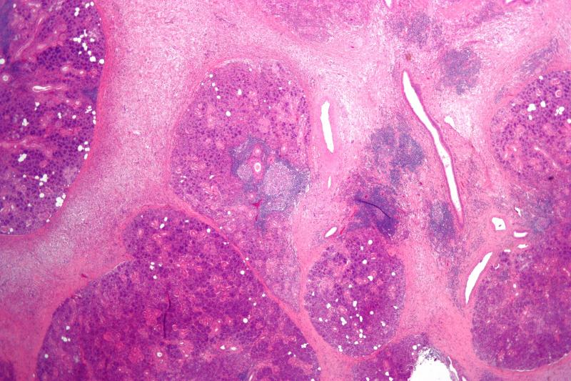 Bacterial Sialadenitis Market