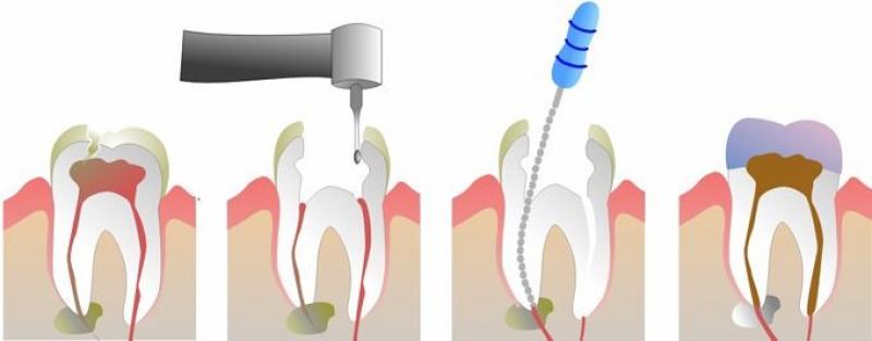 Bioimplants Market Size