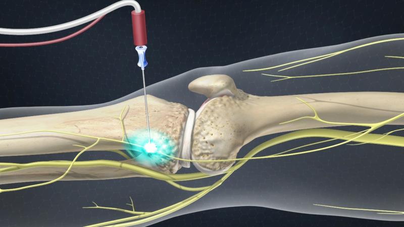 Bone Tumor Ablation Devices Market