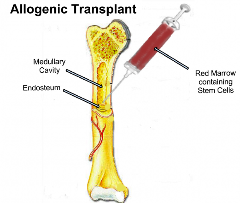 Bone Marrow Transplant Market