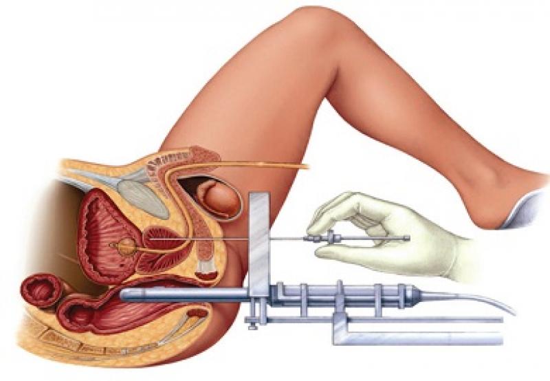 Brachytherapy 