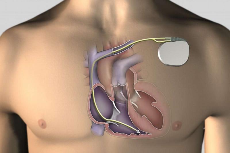 Brazil Cardiac Pacemakers Market