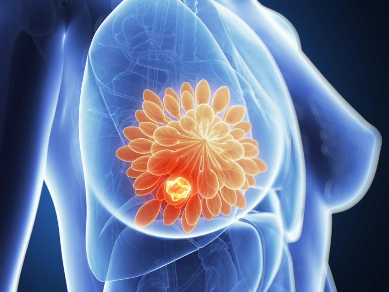 Best Breast Cancer Treatment In Mumbai