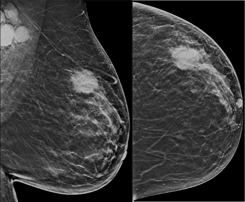 Breast Imaging Market