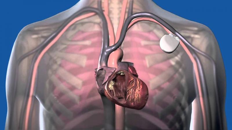 Cardiac Implantable Electronic Device Market