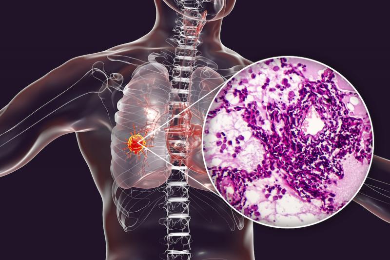 Cancer Biopsy Market