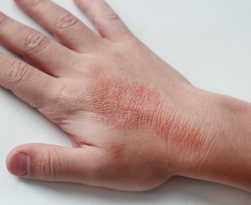 Canine Atopic Dermatitis Treatment Drugs Market