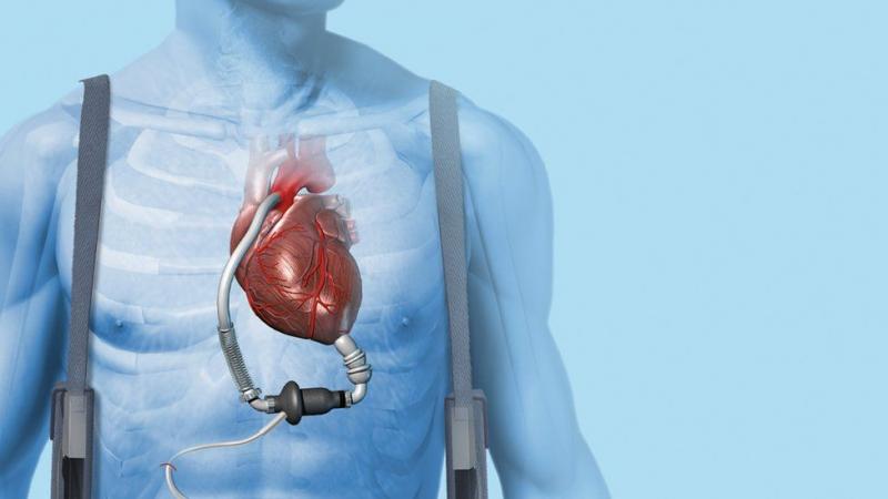 Cardiac Assist Devices Market