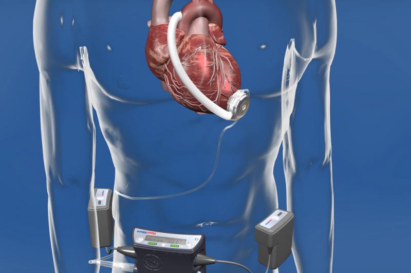 Cardiac Assist Devices