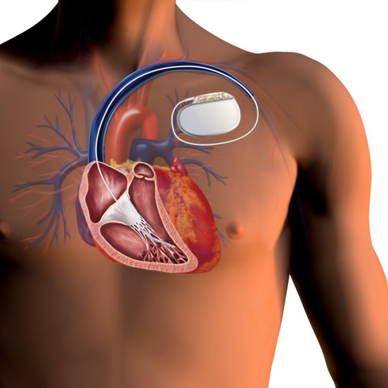 Cardiac Pacemaker