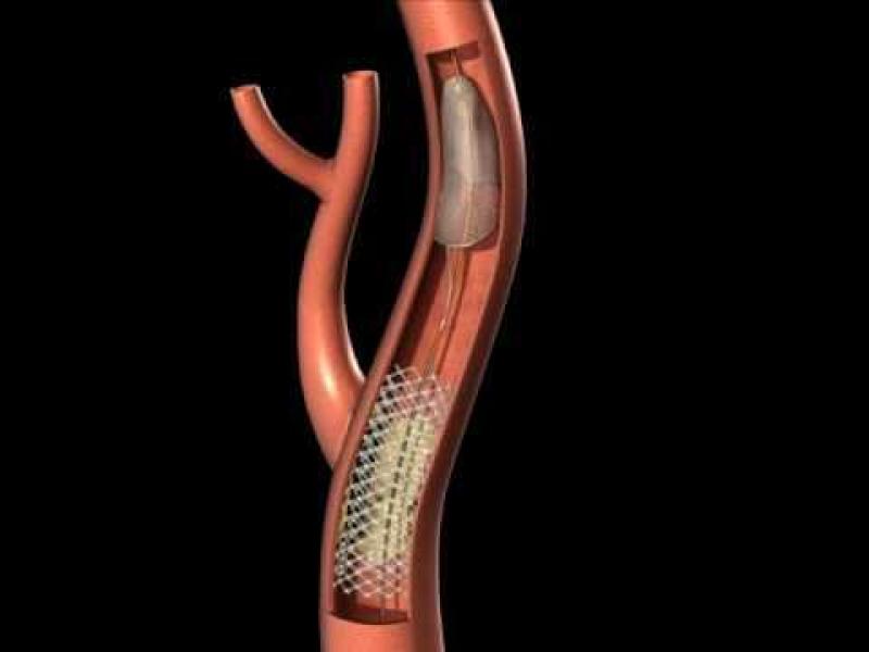 Carotid Stent
