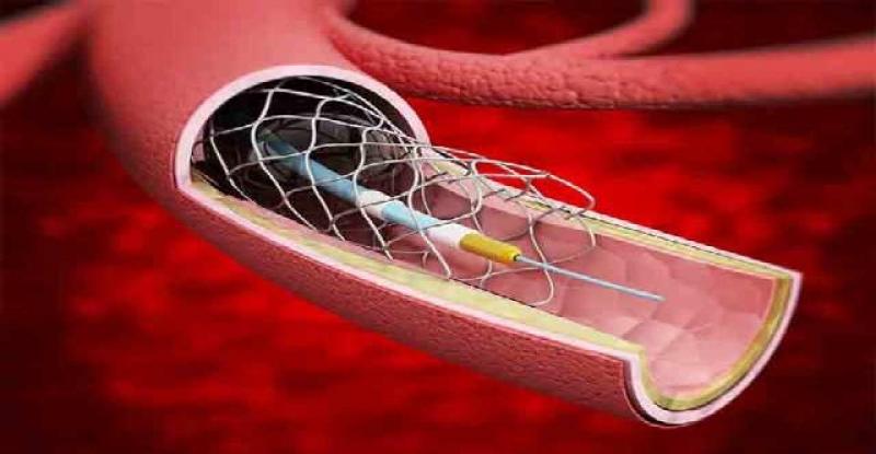 Cerebral Vascular Stent Industry