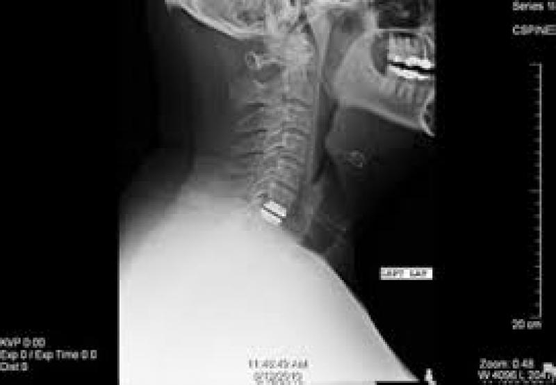 Global Cervical Disc Prosthesis Sales Market Report 2017 Cervical Disc Prosthesis