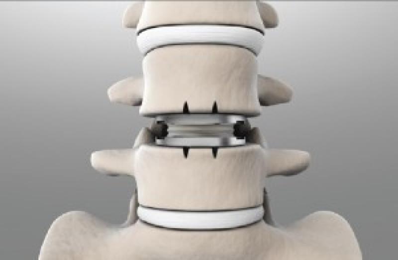Cervical Total Disc Replacement Device Market
