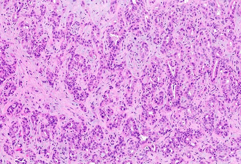 Cholangiocarcinoma Market 