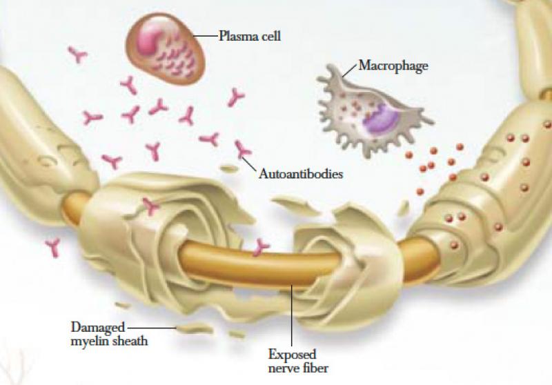 Chronic Inflammatory Demyelinating Polyneuropathy (CIDP) Market 