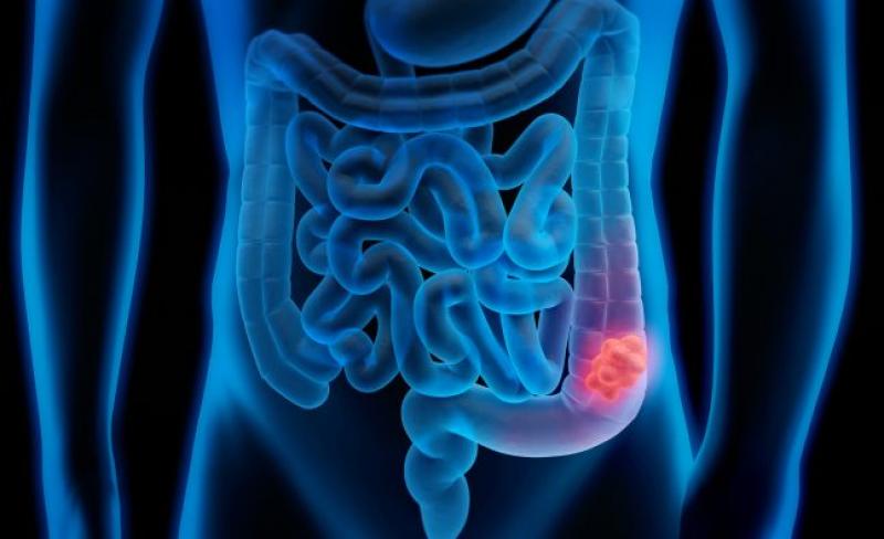 Colon Cancer Treatment In Mumbai