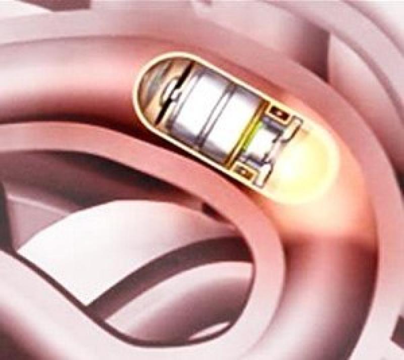 Colon Capsule Endoscopy