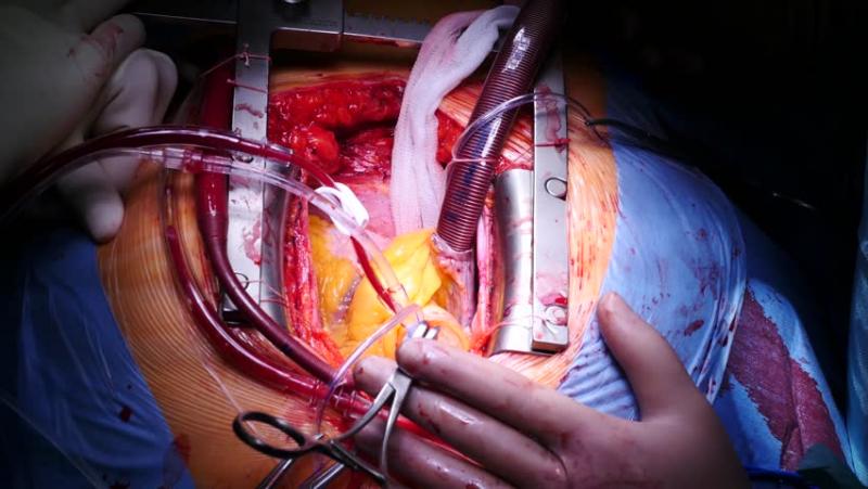 Coronary Artery Bypass Graft Surgery Market