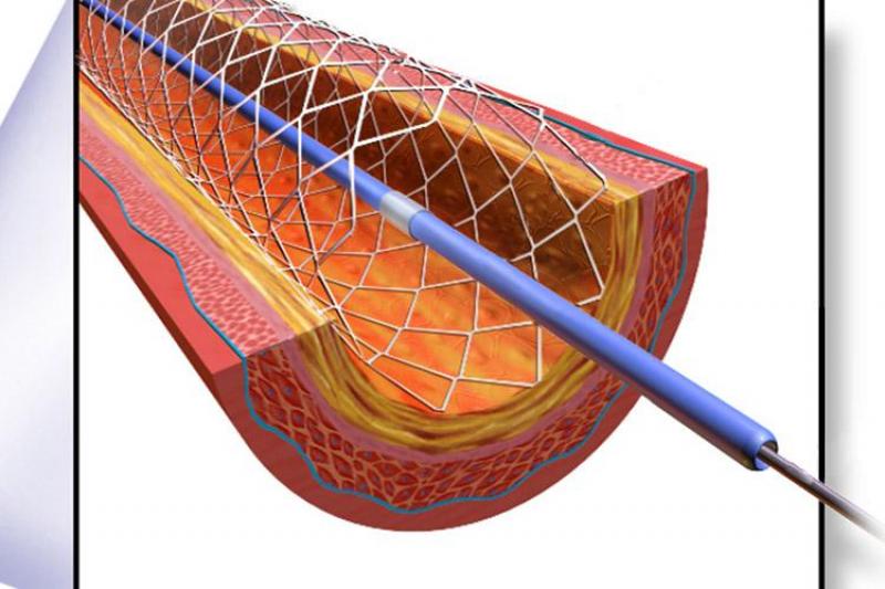 Замена стентов. ЧКВ баллонная ангиопластика. Лазерная коронарная ангиопластика. Катетер лазерная ангиопластика.
