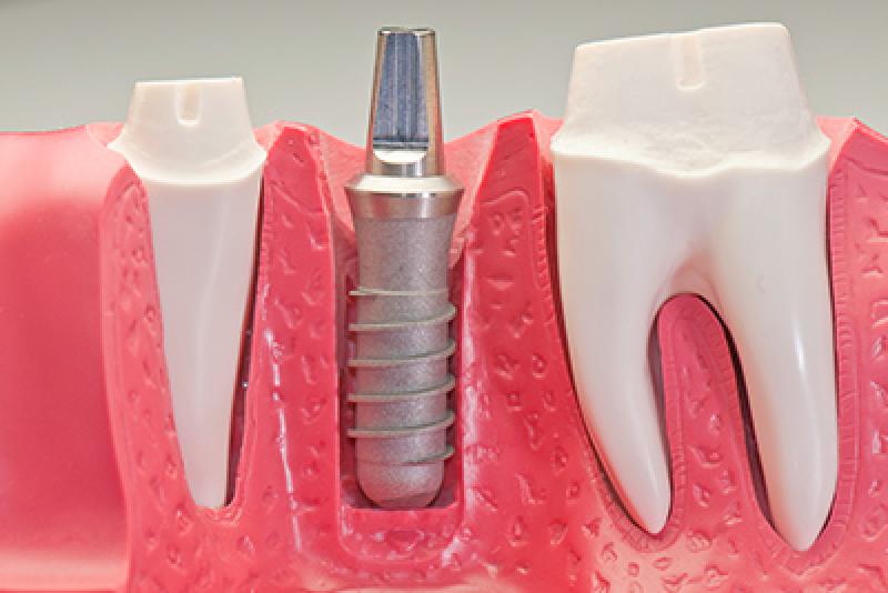 Cosmetic Implant Market