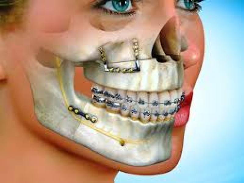 Craniomaxillofacial Fixation (CMF) Devices Market Report 2018 Craniomaxillofacial Fixation (CMF) Devices