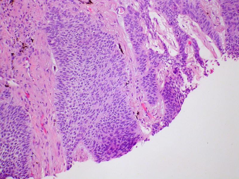 Cutaneous Squamous Cell Carcinoma Treatment Market