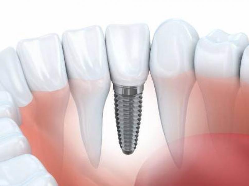 Dental Bone Graft Substitutes Market