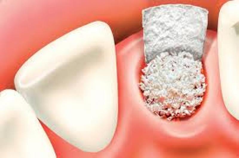 Dental Bone Graft Substitutes